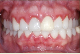 <p><span>a condition when the gums bleed easily. The borders where the gums and the teeth meet may look red. If the teeth are cleaned, and plaque and tartar are removed, the swelling and redness go away. Can be stopped from getting worse and its effects can be reversed.</span></p>