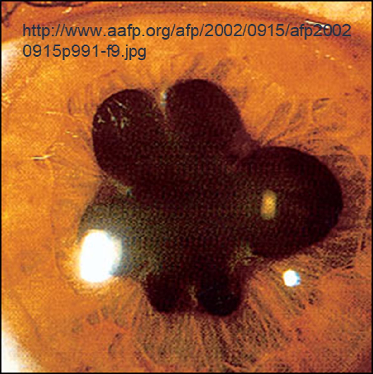 <p>OD does not react directly or consensually = look at OS direct and consensual responses = if OS constricts when pupil is shined into either eye, then there is NO APD in either eye</p>