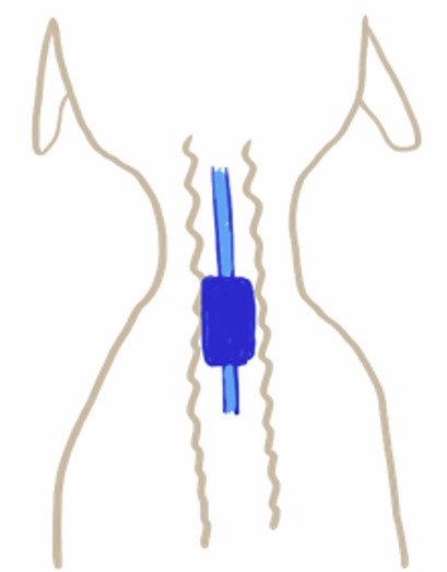 <p>&quot;single use&quot; ET tubes with high volume, low pressure cuffs. These are clear so you can see blockages and condensation. Cleaning can make them brittle</p>