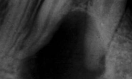 <p>What symptoms occur with a periapical cyst?</p>