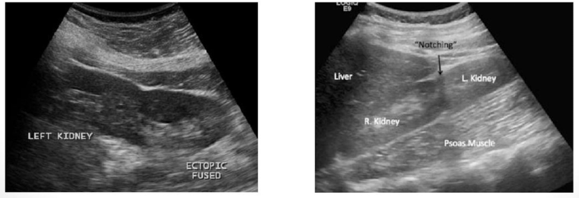 <p>both kidneys are located on one side of the body. What type of ectopic kidney is this:</p>