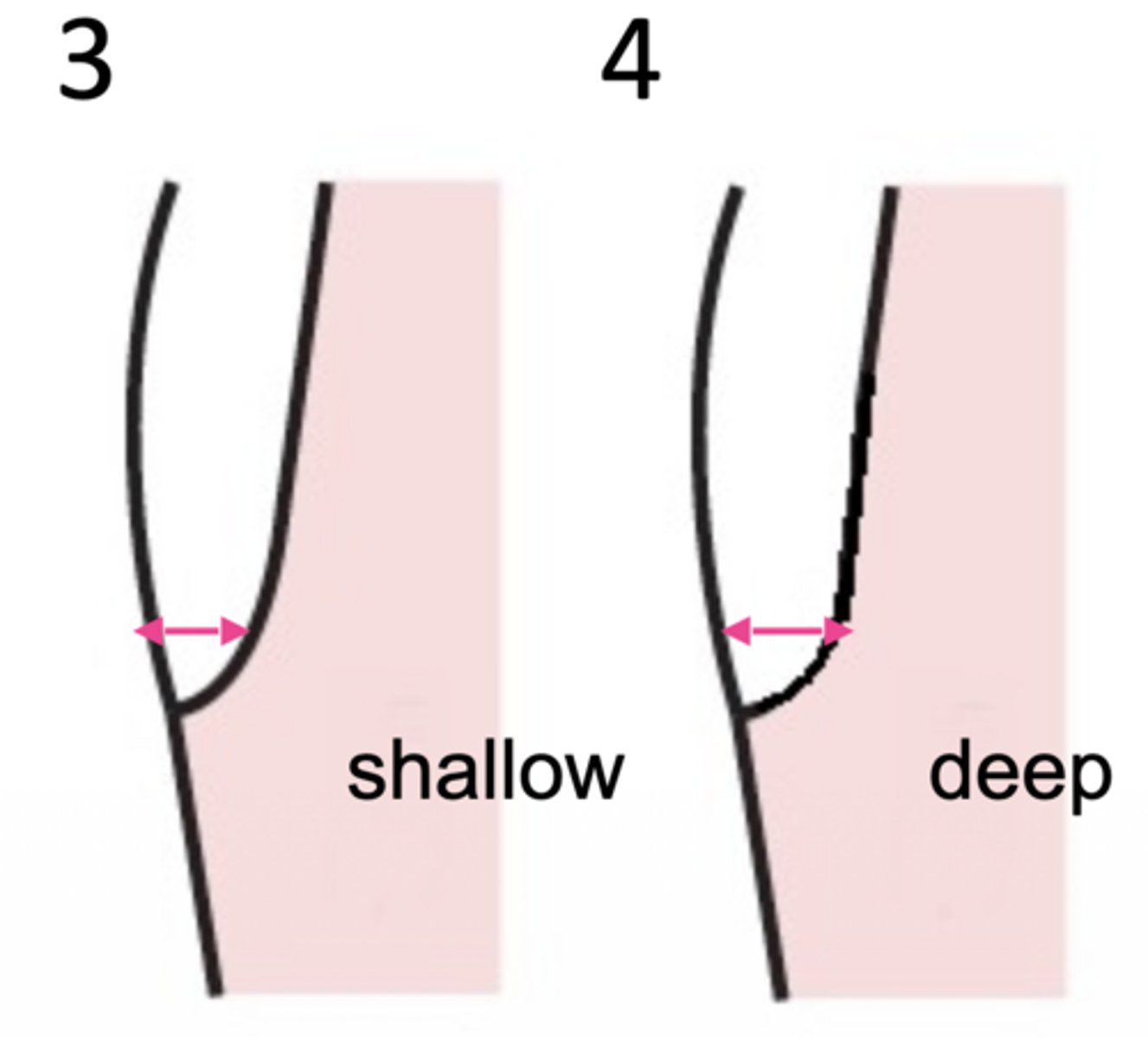 <p>What type of margin design is at 4?</p>