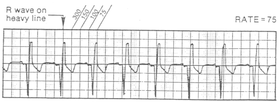 <ul><li><p>assigns rate (number) to each vertical line</p></li><li><p>locate R wave that falls on (or near) thick vertical line)</p></li><li><p>count each thick line</p><ul><li><p>300-150-100-75-60-50-43-38-33-30</p></li><li><p>until next R wave</p></li></ul></li></ul><p></p>