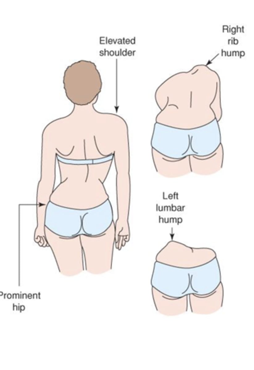 <p>Uneven shoulders or iliac crest</p><p>Prominent scapula on convex side of curve</p><p>Asymmetry of thoracic cage</p><p>Treatments:</p><p>- Depend on severity and likelihood to progress</p><p>- Curves 20-30°: Considered</p><p>- Curves 30-40°: Bracing</p><p>- Curves 40-45°+: Surgery</p>