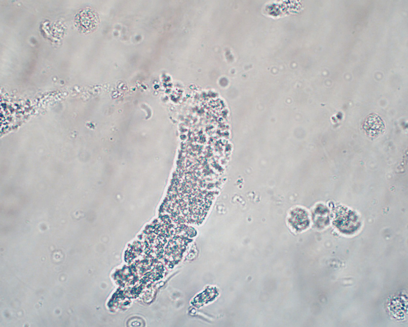 <p>Indicates infection or inflammation w/n nephron</p><ul><li><p>“Pyelonephritis”</p></li></ul><p></p>