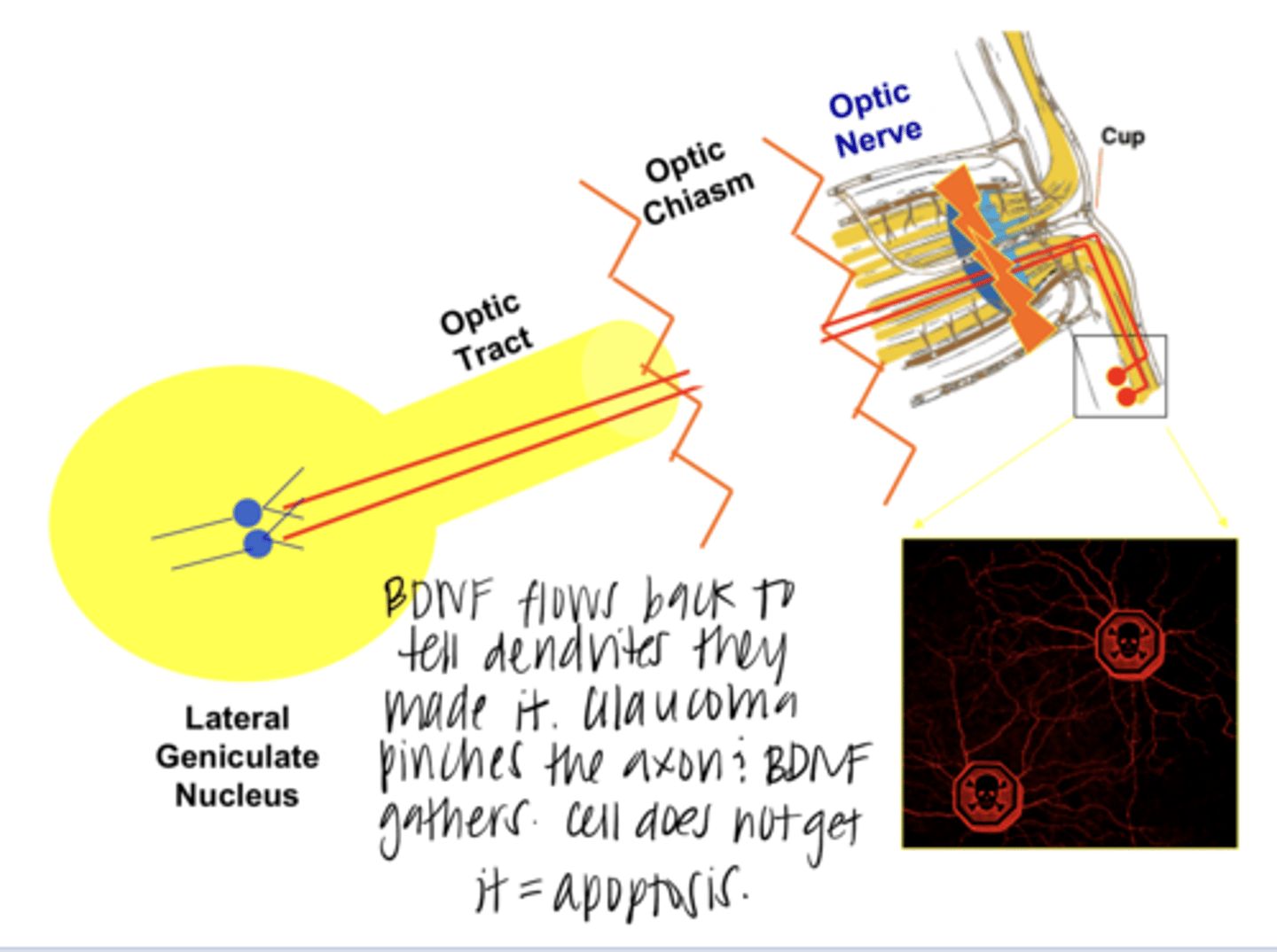 <p>What is the neurotrophic deprival hypothesis that explains why RGCs die in glaucoma?</p>