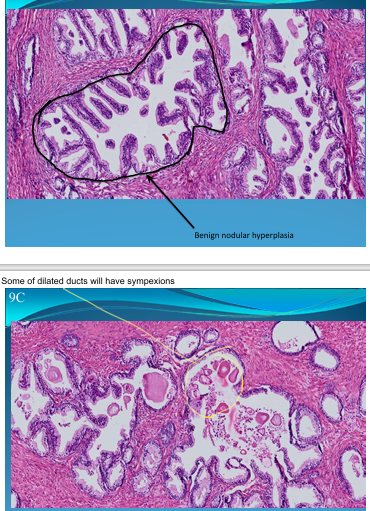 <p>PROSTATE:</p><p>Benign Nodular Hyperplasia: fibrosis, muscular hyperplasia - dilated ducts with fern leaf aspect and some with sympexions </p>