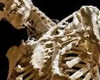<p>What is FOP, or Fibrodysplasia Ossificans Progressiva</p>