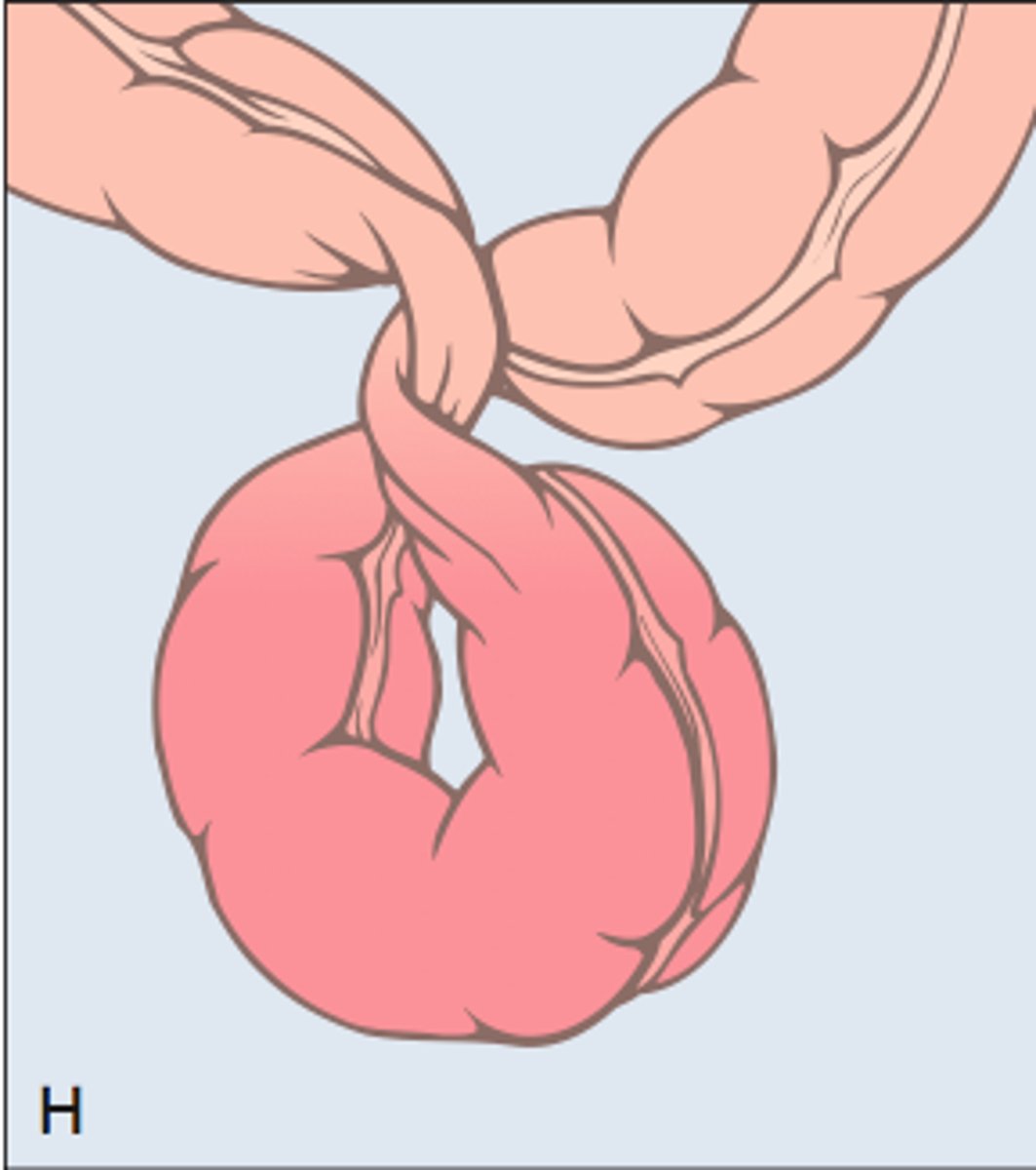 <p>twisting of the intestine on itself</p>