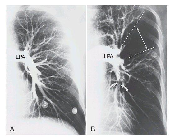 <p>It is a radiographic test used to evaluate blood vessels and the circulation (Figure 5-1). Radiopaque material is injected through a catheter inserted in the blood vessel, and images are recorded using standard radiographic techniques</p>