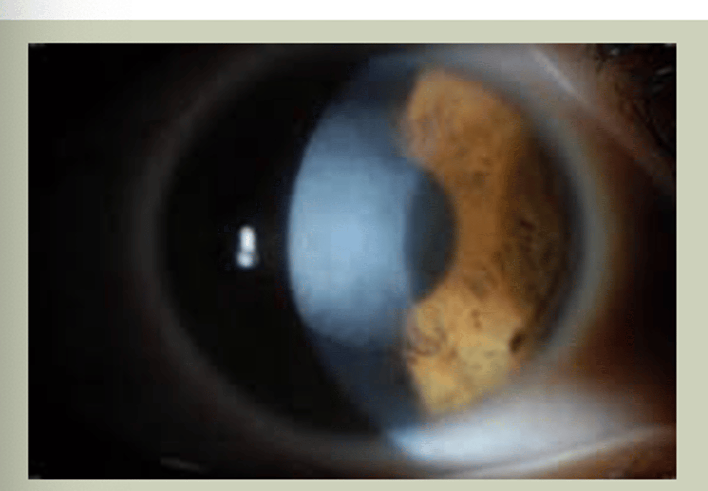 <p>-Pt has predisposed condition to corneal scarring or previous infection</p><p>-Can be bilateral/unilateral based on etiology</p><p>-Glasses/Contact lenses will only correct up to point</p>
