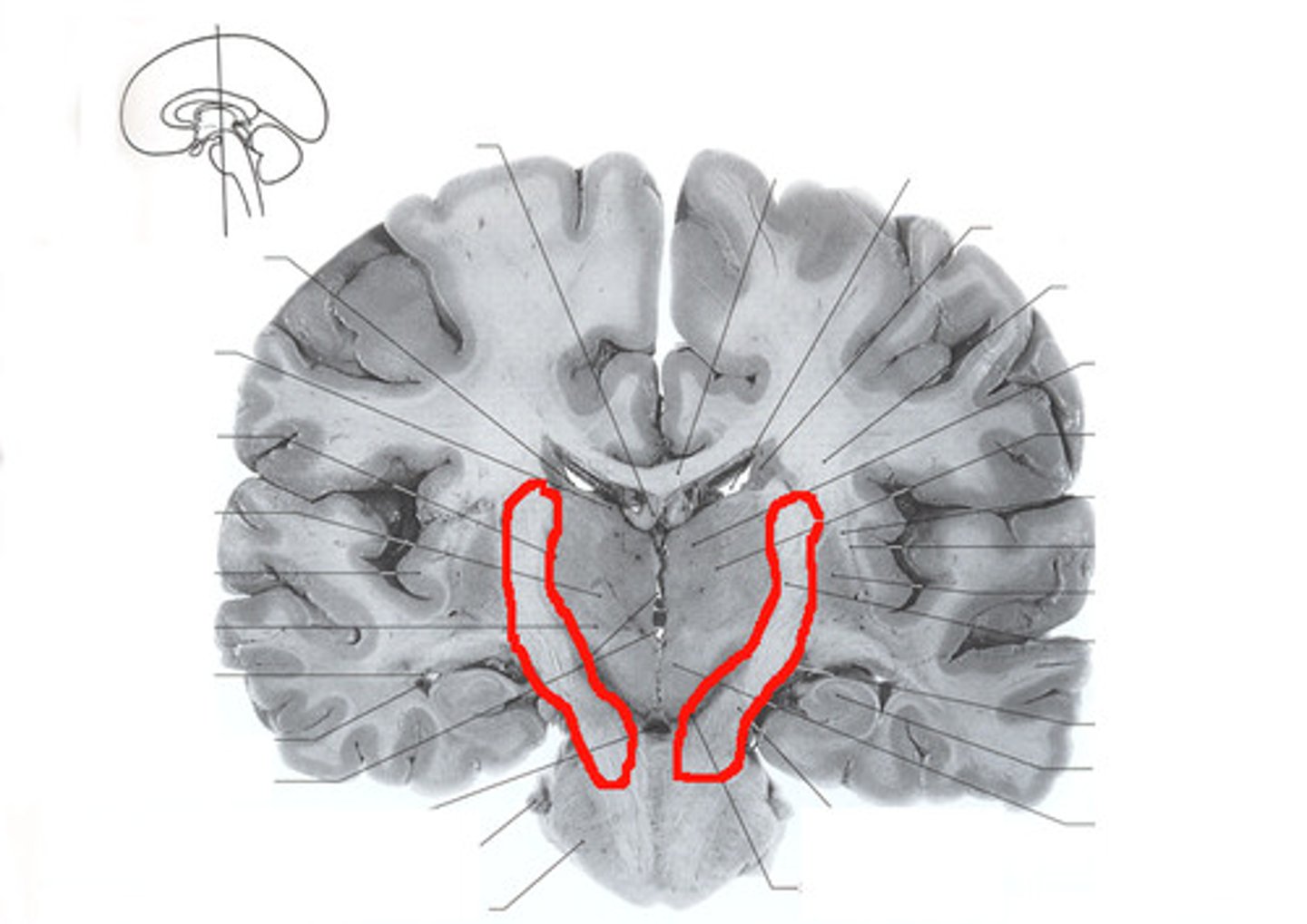 <p>A white matter structure situated in the inferomedial part of each cerebral hemisphere of brain. It carries information past the basal ganglia, separating the caudate nucleus and the thalamus from the putamen and the globus pallidus.</p>