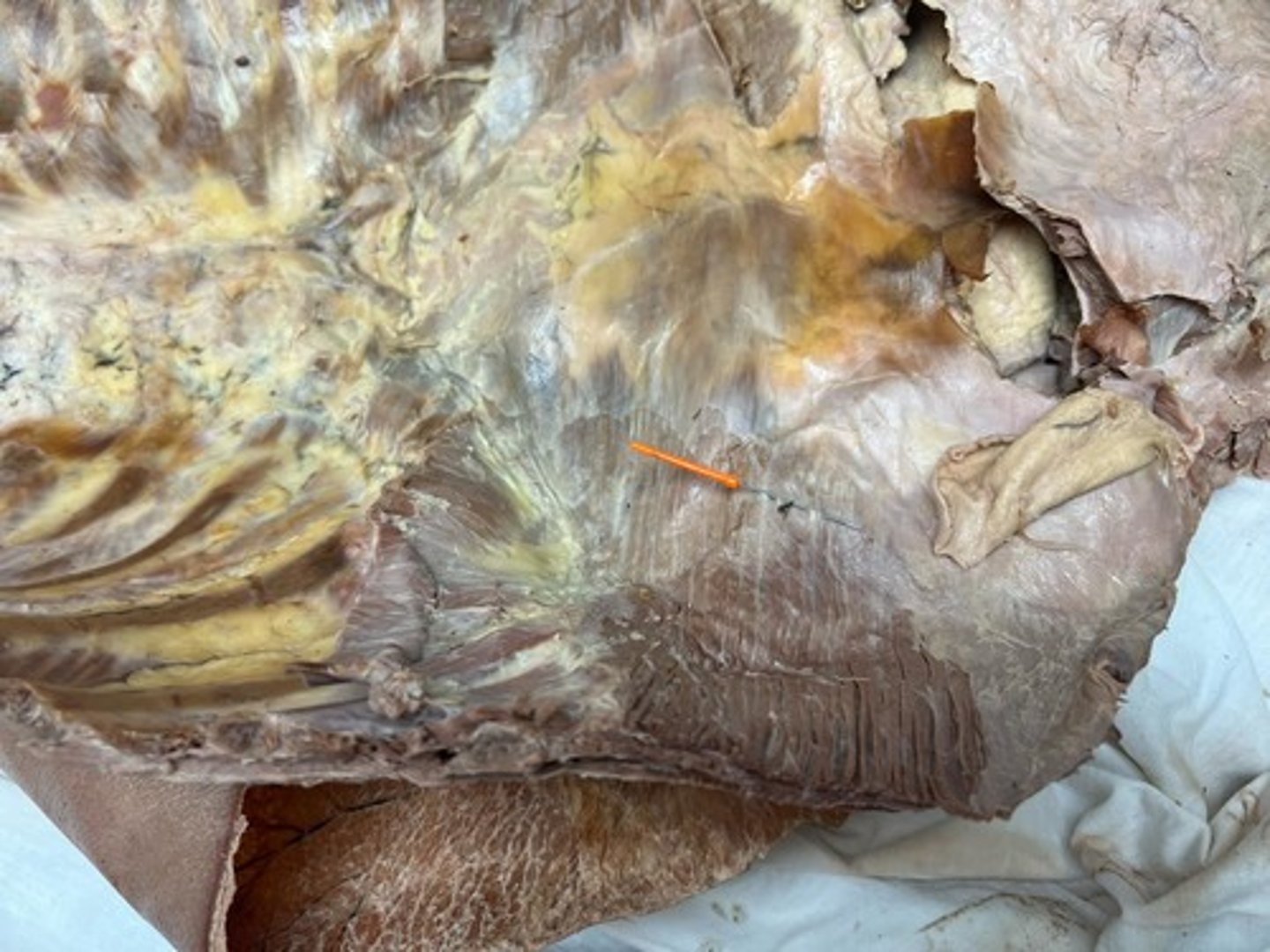 <p>transversalis fascia</p>