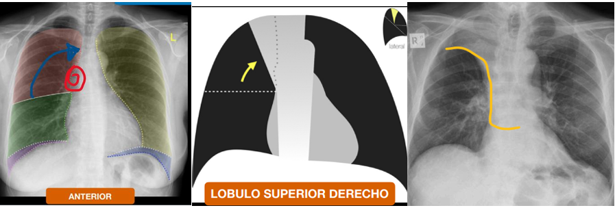 <ul><li><p>puede ser causado por un tumor que obstruye el bronquio</p></li><li><p>la cisura menor se desplaza hacia arriba, y se observa la<strong> S invertida de GOLDEN.</strong></p></li></ul><p></p>