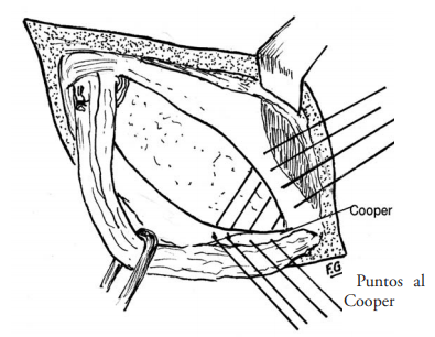 <p>correção de hérnia femoral <br>sutura tendão conjunto (fusão tendão transverso + oblíquo interno) ao longo do lig. pectíneo (cooper) para tamponar canal femoral = não usa tela</p>