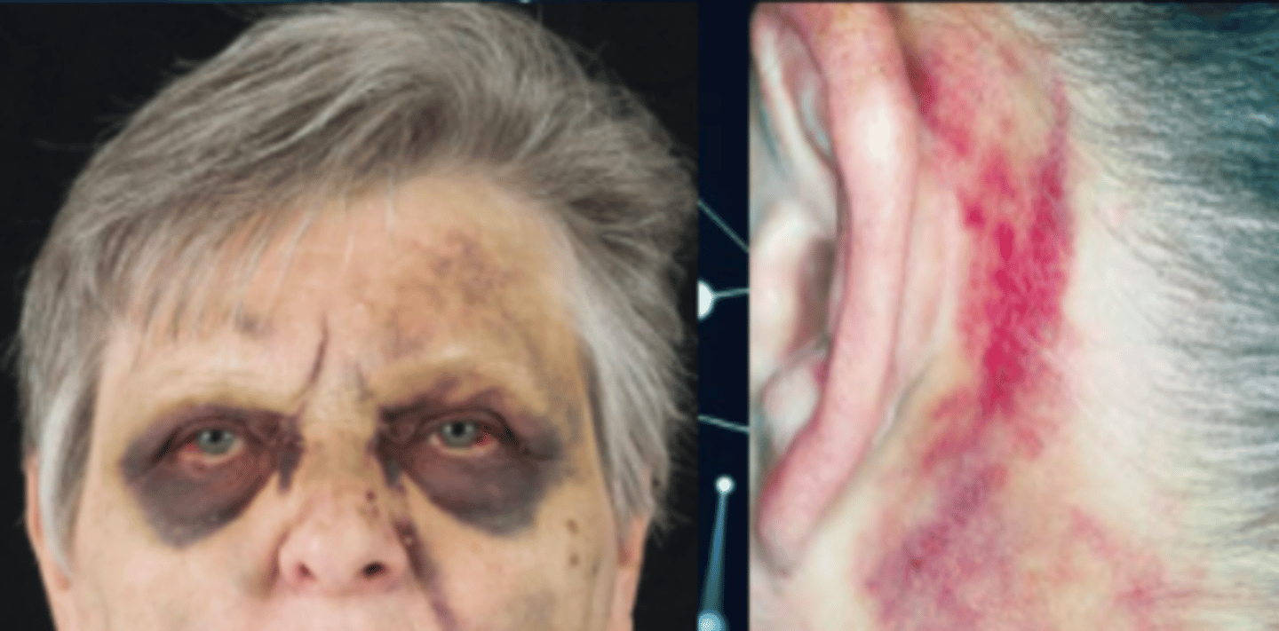 <p>What are these two signs of trauma:</p>