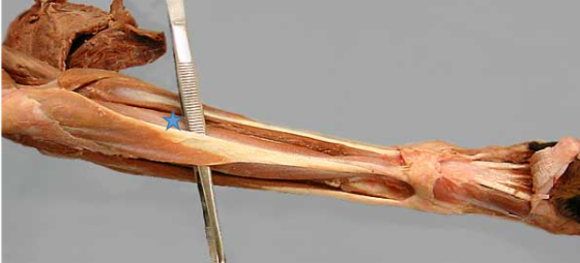 <p>Deep digital flexor m.</p>