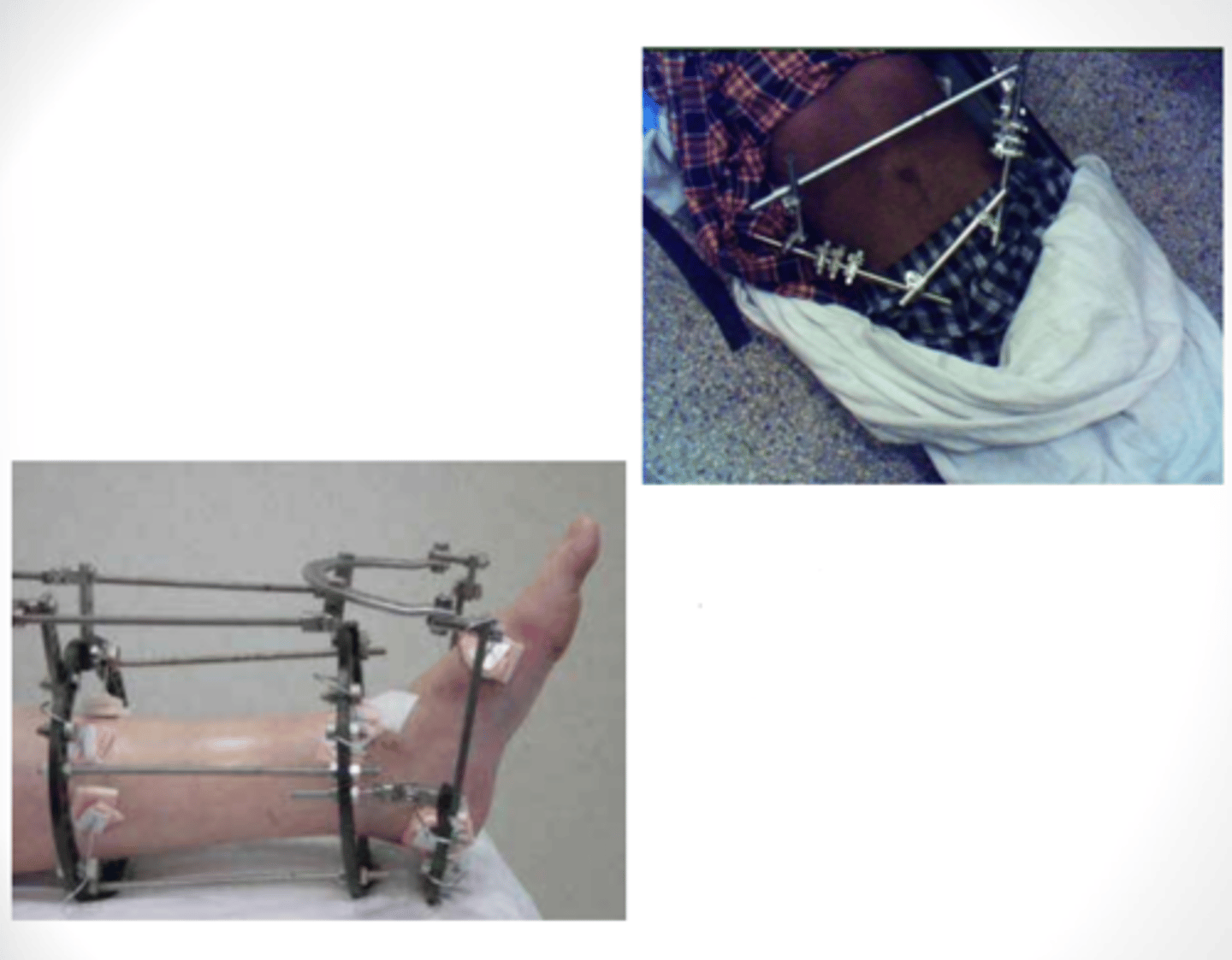 <p>Do not lift /c rods of external fixation device! Use _______________________ to create a sling when possible.</p>