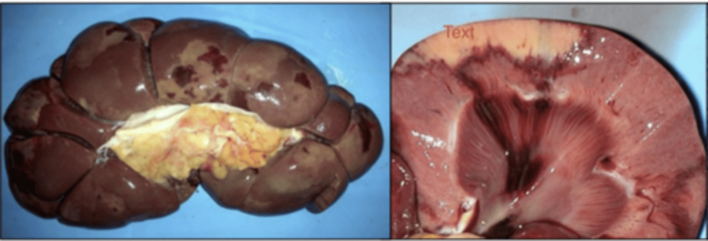 <p>coagulative necrosis</p>