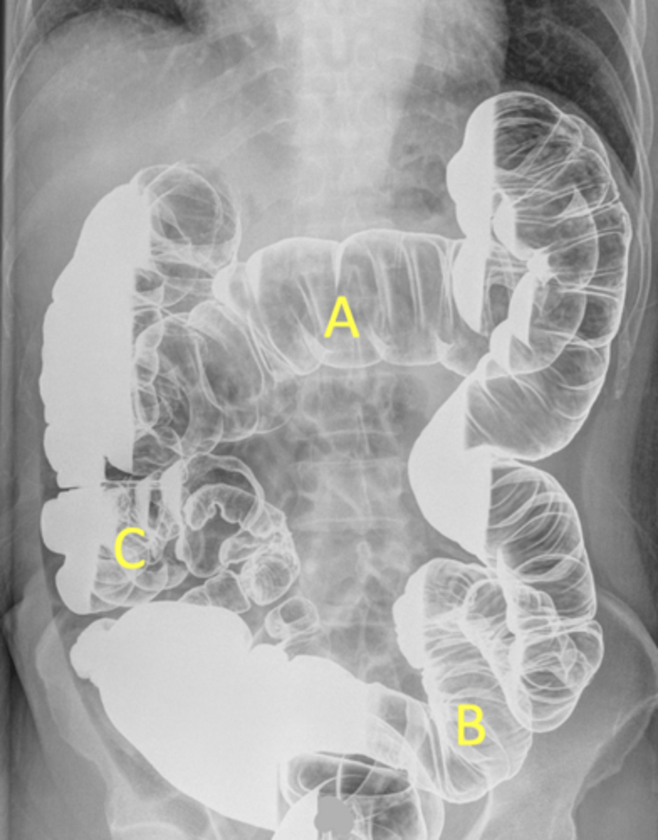 <p>Fluid settles on the down side, and air rises to the up side.</p>