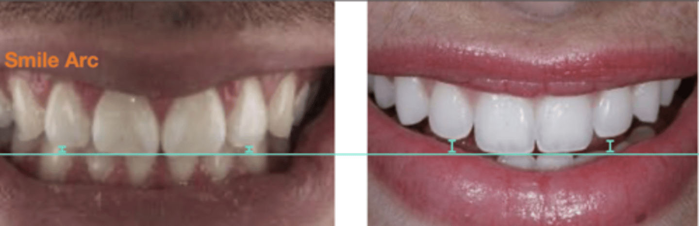 <p>shorter incisal edges</p>