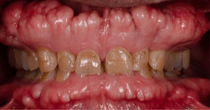<p>a benign bony growth on the jawbone</p>