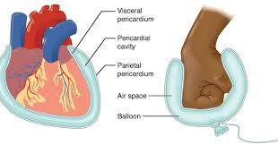 <p>Cardiac tamponade results in ineffective pumping of blood by the heart. This is because the excessive amount of fluid in the pericardial cavity will ______.</p><table style="min-width: 25px;"><colgroup><col style="min-width: 25px;"></colgroup><tbody><tr><td colspan="1" rowspan="1" style="margin: 0px; padding: 0.3em; position: relative;"><p>prevent the visceral layer of the serous pericardium from properly surrounding the heart</p></td></tr><tr><td colspan="1" rowspan="1" style="margin: 0px; padding: 0.3em; position: relative;"><p>prevent the heart from filling properly with blood</p></td></tr><tr><td colspan="1" rowspan="1" style="margin: 0px; padding: 0.3em; position: relative;"><p>prevent proper oxygenation of the blood</p></td></tr><tr><td colspan="1" rowspan="1" style="margin: 0px; padding: 0.3em; position: relative;"><p>interfere with the ability of this fluid to lubricate the serous membranes</p></td></tr></tbody></table><p></p>
