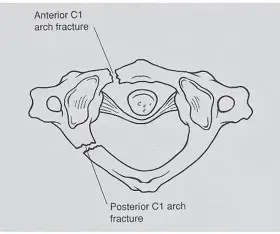 <p>straight on Atlas </p>