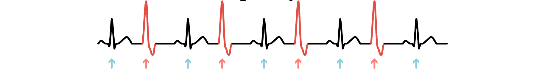 <p>What are the signs and symptoms a client would display if symptomatic with this rhythm?</p>