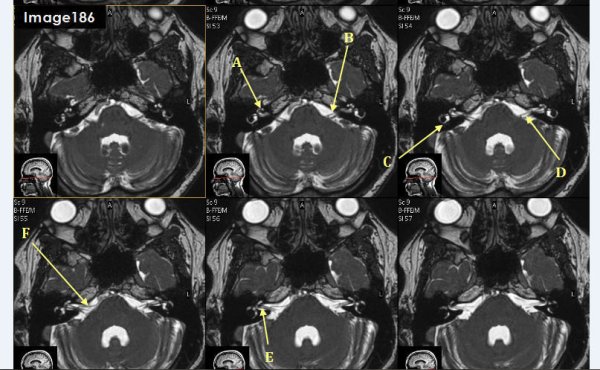 <p>Letter F in Image 186 is pointing to which cranial nerve?</p>