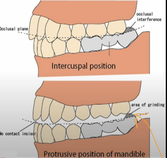 <p>May look normal during the static occlusion, however during the protrusion last molar, interferes with the smooth movement (dynamic occlusion)</p><p>Can damage muscles, causing TMJ problem</p>