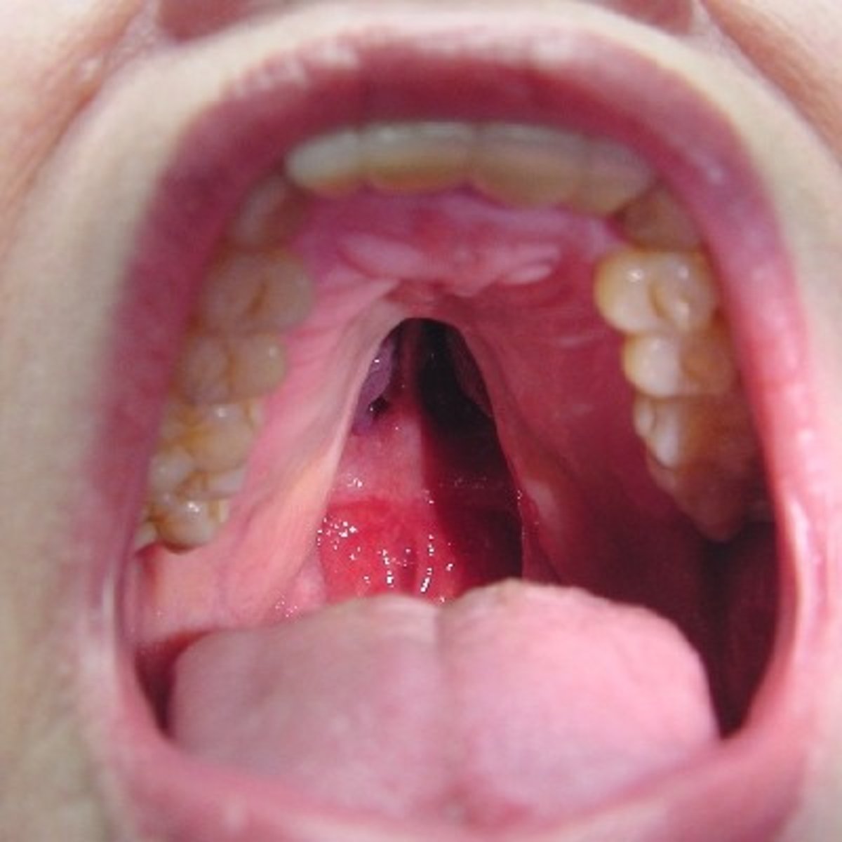 <p>• Image asking what most significant thing in picture is?</p><p>cleft palate</p><p>missing uvula</p><p>cleft palate</p>