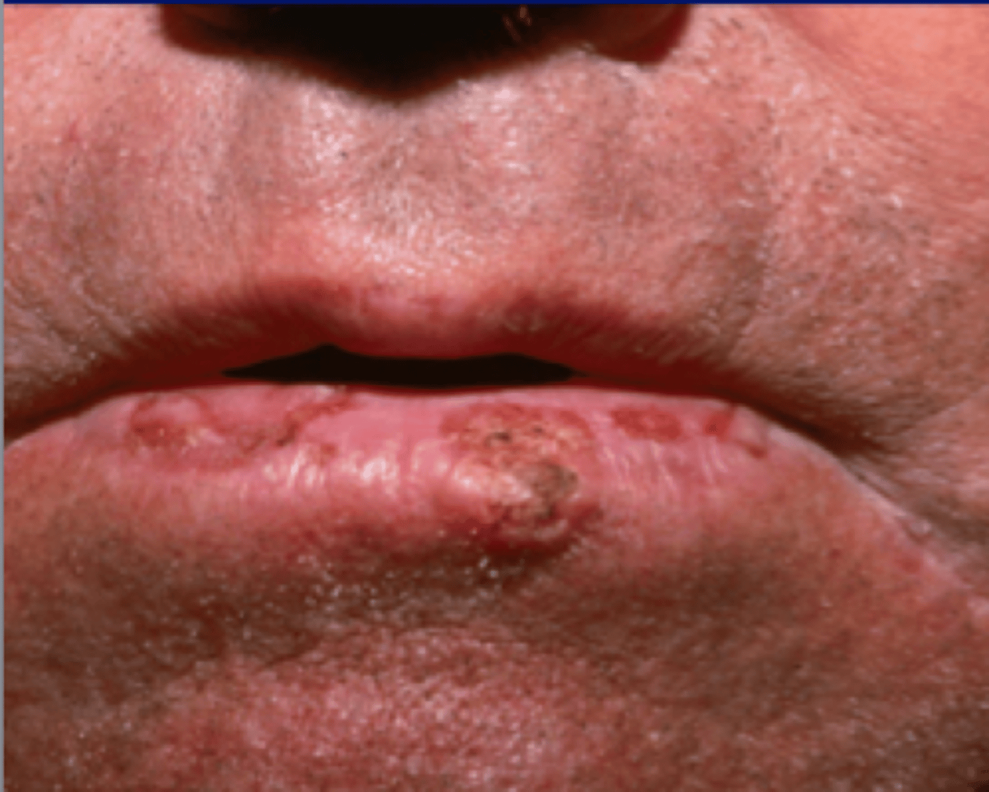 <p>AKA solar cheilitis; loss of vermillion border </p><p>• dry, cracked lesion</p><p>• common location: lower lip</p><p>• population: fair skinned adults over 40</p><p>• dysplasia = pre-cancerous </p>