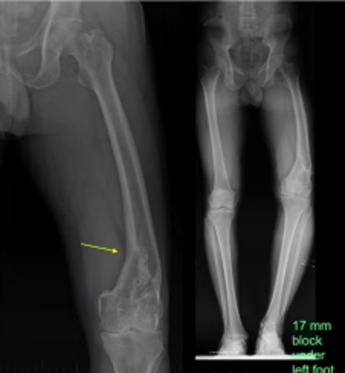 <p>Which late fracture complication is shown in this X-ray?</p>