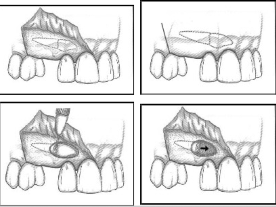 <p>Infraorbital, nasopalatine, medium palatine from corresponding side</p><p>Bilateral- Newman from 1.5 to 2.5 with vertical relieving incisions&nbsp;</p><p>Unilateral- partial Newman from same side central incisor to dusta; 2nd premolar- M/D relieving incision&nbsp;</p>