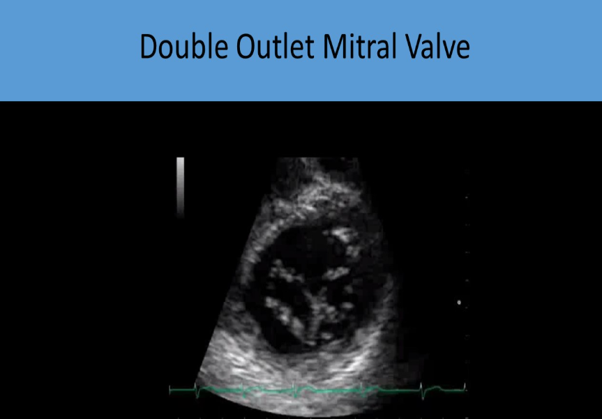 <ul><li><p>accessory orifice</p></li><li><p>psax best to visualize</p></li><li><p>flow eval may be normal or appear w signs of stenosis/regurg</p></li></ul><p></p>