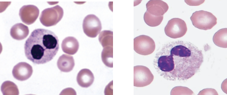 <p>which state of pelger huet anomaly&nbsp;refers to the following:</p><ul><li><p>bi-lobed nucleus </p></li><li><p>dense heterochromatin </p></li><li><p>incomplete nuclear segmentation </p></li><li><p>aka dumbbell or prince nez</p></li></ul><p></p>