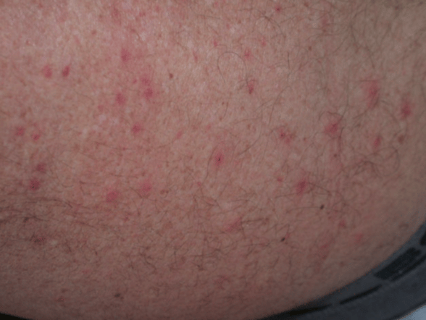 <p>Superficial infection of the Hair follicle</p><p>Etiology</p><p>-P. Aeruginosa</p><p>Risk Factors</p><p>-Pool H2O</p><p>Sx</p><p>-Pruitic Papulopustular rash</p>