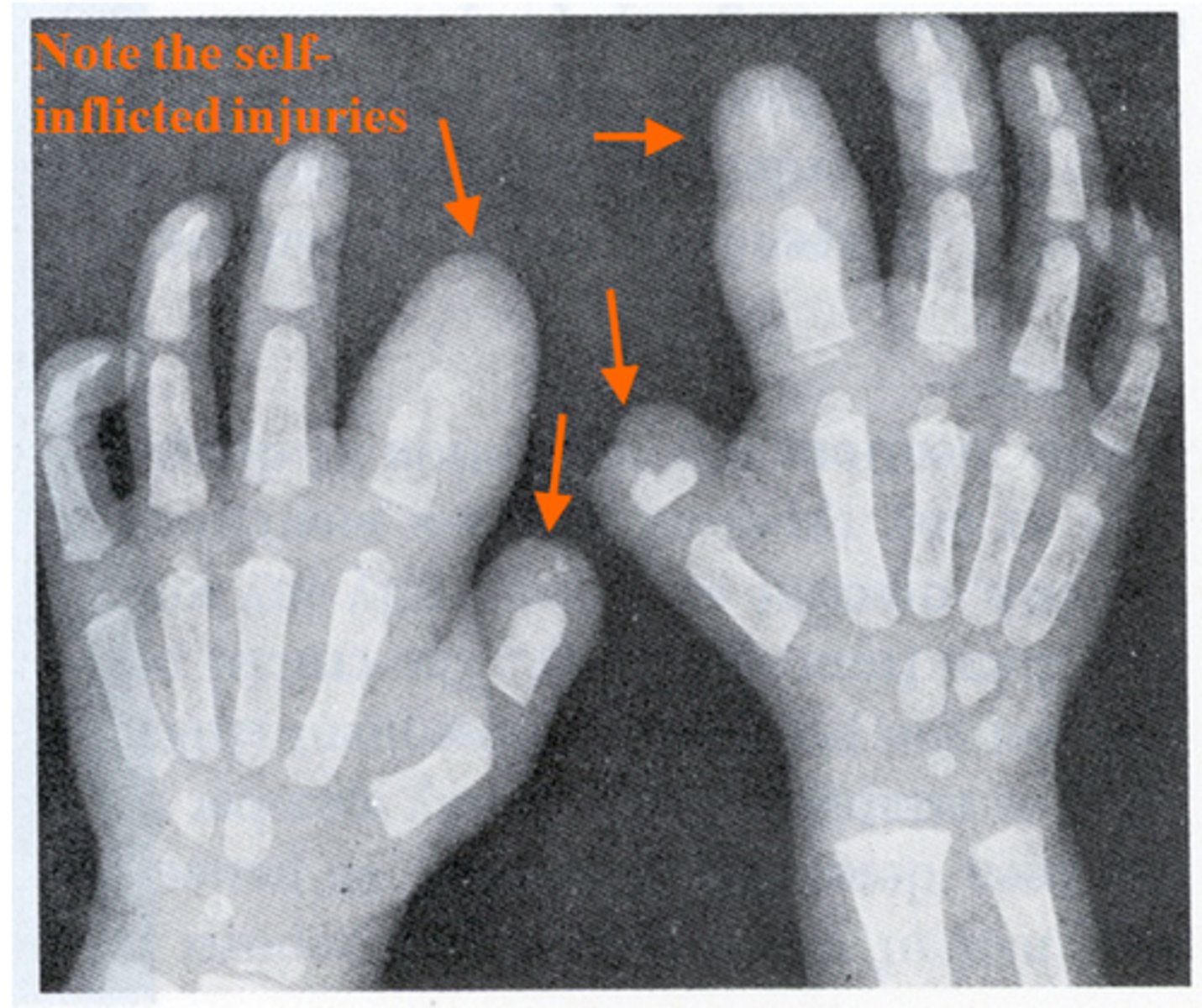 <p>pain stimulus is NOT EVEN DETECTED<br>- leads to major injury<br>- most common in children because child cannot inform parent when they are experiencing discomfort</p>