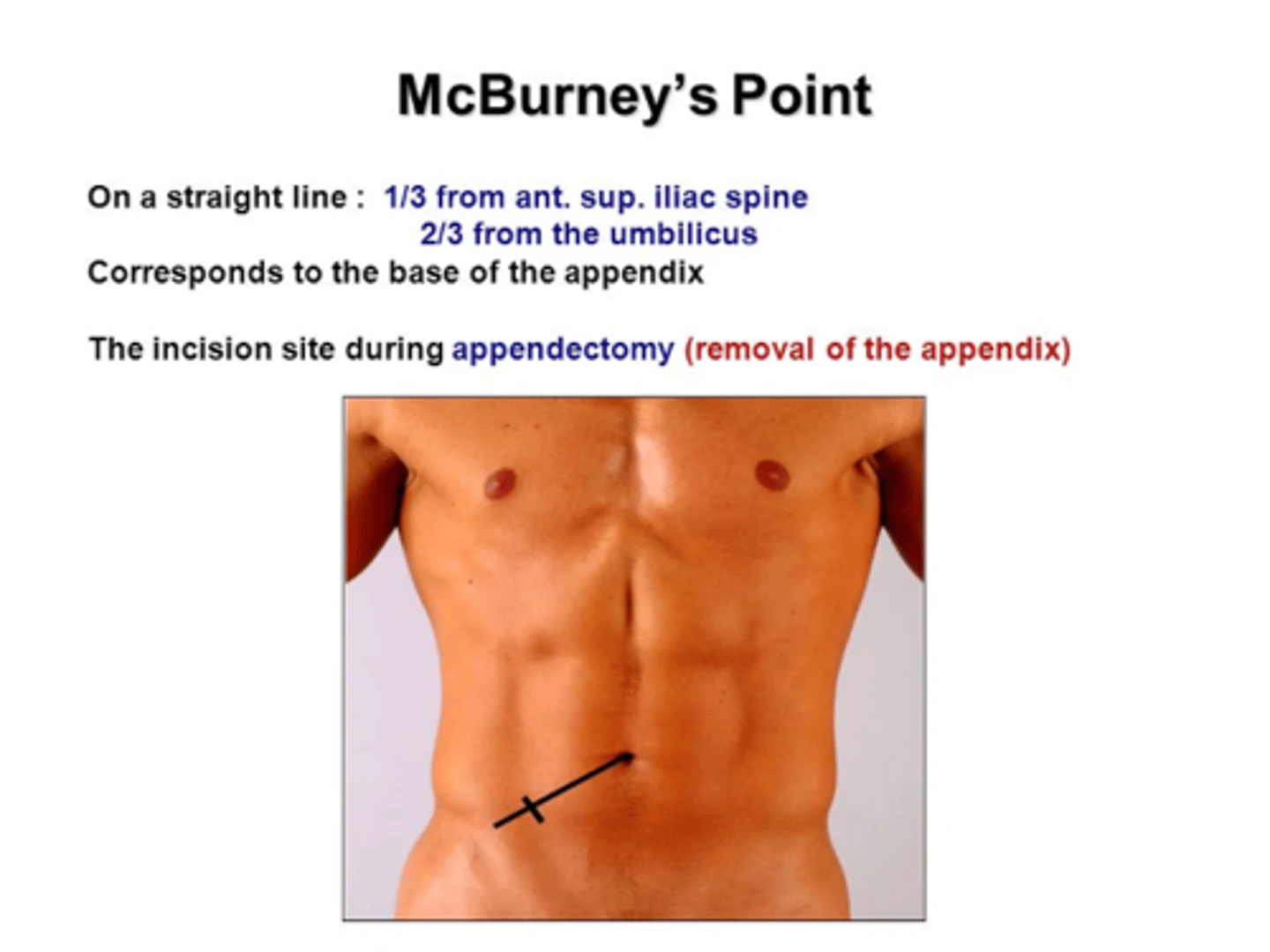 <p>Right side of the abdomen</p><p>corresponds with the appendix</p><p>incision site during appendectomy </p>