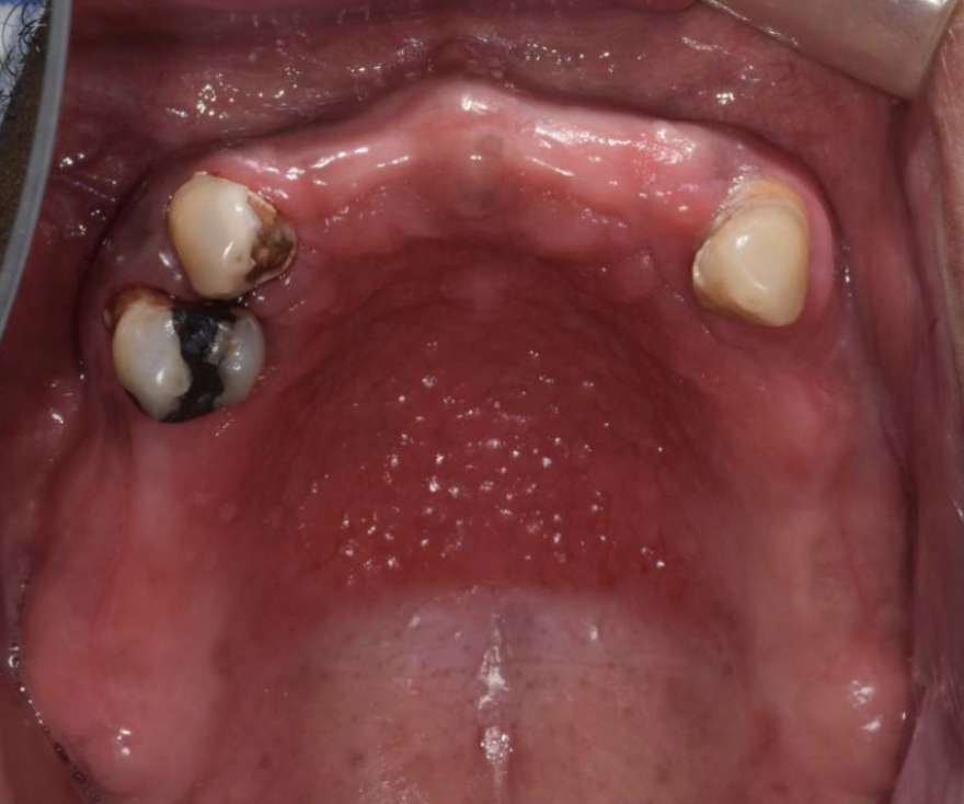 <ul><li><p>on hard palate beneath denture base</p></li><li><p>pink/red pebbly mucosa</p><ul><li><p>erythema = secondary candidal infection</p></li></ul></li></ul><p></p>