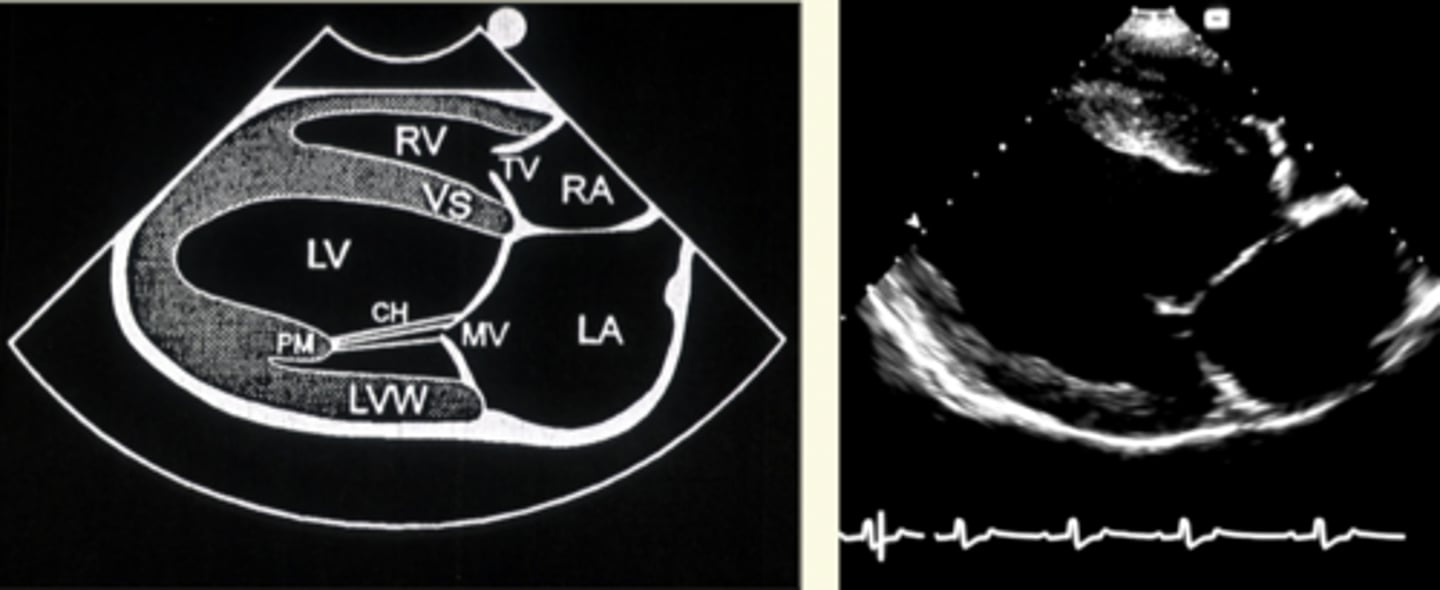 <p>mitral; aortic</p>