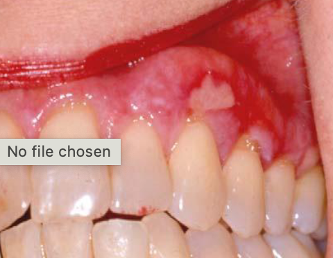 <p>immune mediated disease causing ulcerations and erythema, PAINFUL </p>