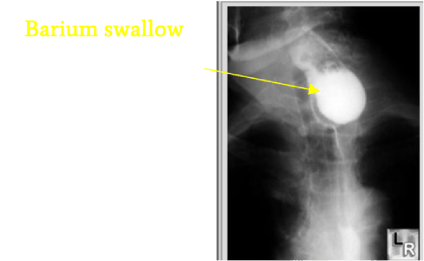 <p>Define Diverticulum Type:</p><p>FALSE Diverticulum (only mucosa + submucosa) - occurs at esophagus-pharynx junction</p><p>-Hx:</p><p>&gt; Elderly</p><p>&gt; D/t Chronic Swallowing problem</p><p>-Path: Located at Killian's Triangle/dehiscence (focal weakness in hypopharynx) btwn cricopharyngeal muscle and thyropharyngeal muscle</p><p>&gt; Failure to relax → difficulty swallowing → chronic high pressure in pharynx to force food down ==&gt; OUTPOUCHING</p><p>-Sx:</p><p>&gt; Dysphagia</p><p>&gt; Haltosis</p><p>&gt; Regurgitation</p><p>&gt; Gurgling</p><p>&gt; Aspiration</p><p>-Dx: Barium Swallow</p>
