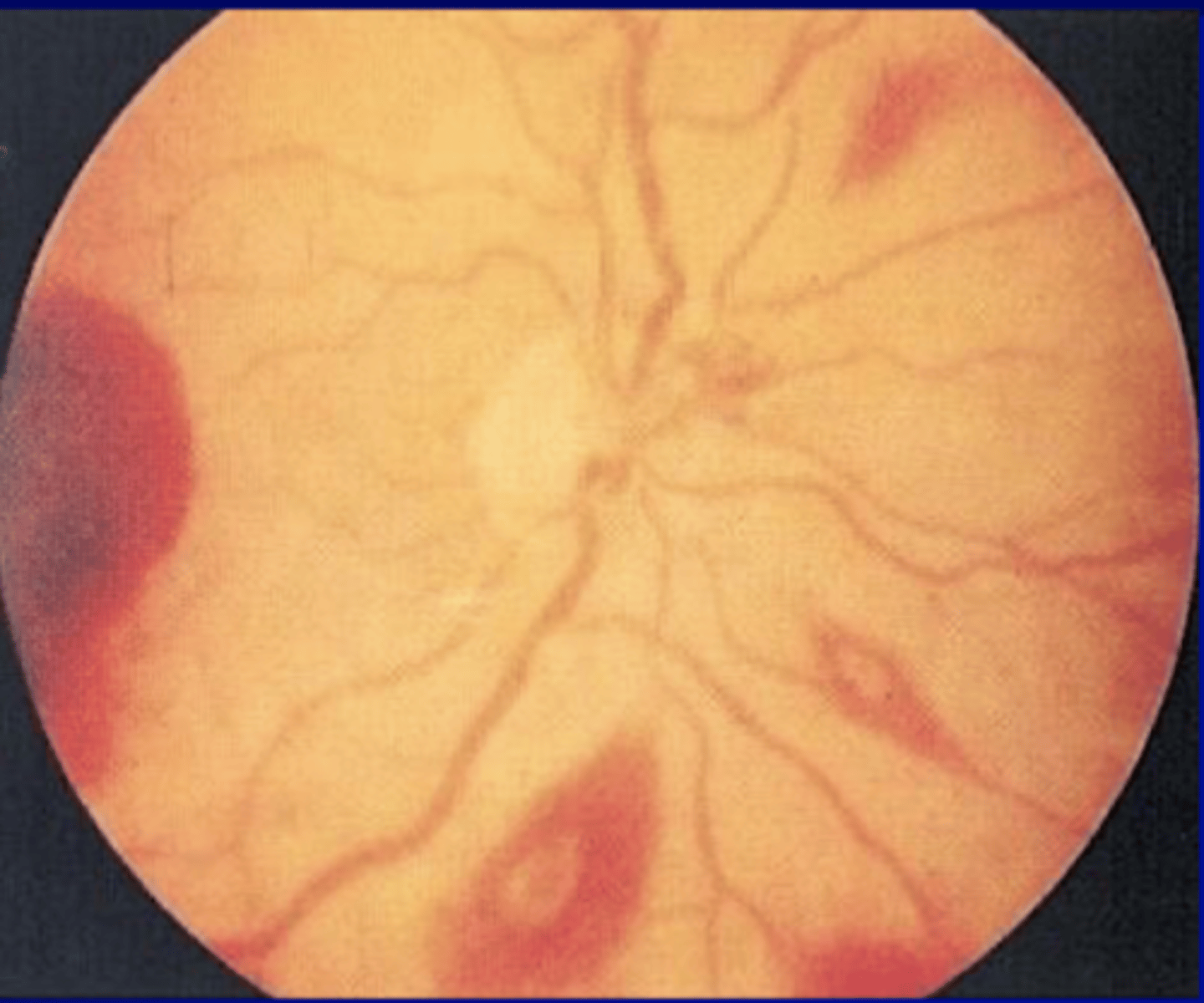 <p>retinal hemorrhages with pale center</p>