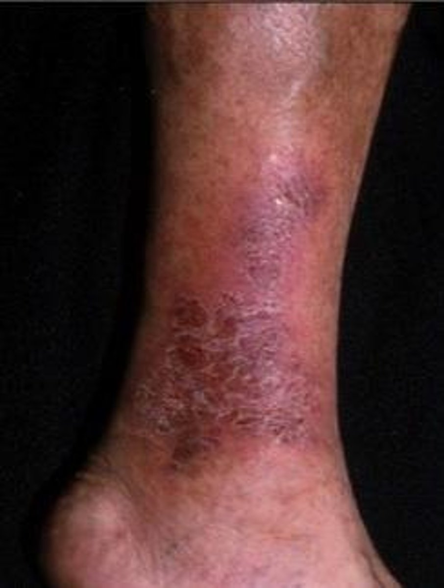 <p>Heme/iron leaks out of capillary into tissue due to chronic increased venous pressure</p>