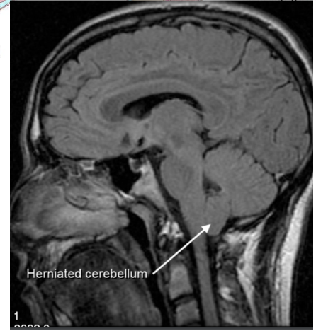<ul><li><p>Cerebellar signs –</p><ul><li><p>Ex. ataxia (lack of coordination), vertigo (spinning), nystagmus (eye fuckery)</p></li></ul></li><li><p>Brainstem signs</p><ul><li><p>Ex. respiratory &amp; cardiac arrest, or signs relating to them</p></li></ul></li><li><p>Cranial nerves stretching (CN IX, X, XII) – dysphonia, difficulty in swallowing, vocal cord paralysis, diminished gag reflex&nbsp;</p></li></ul>
