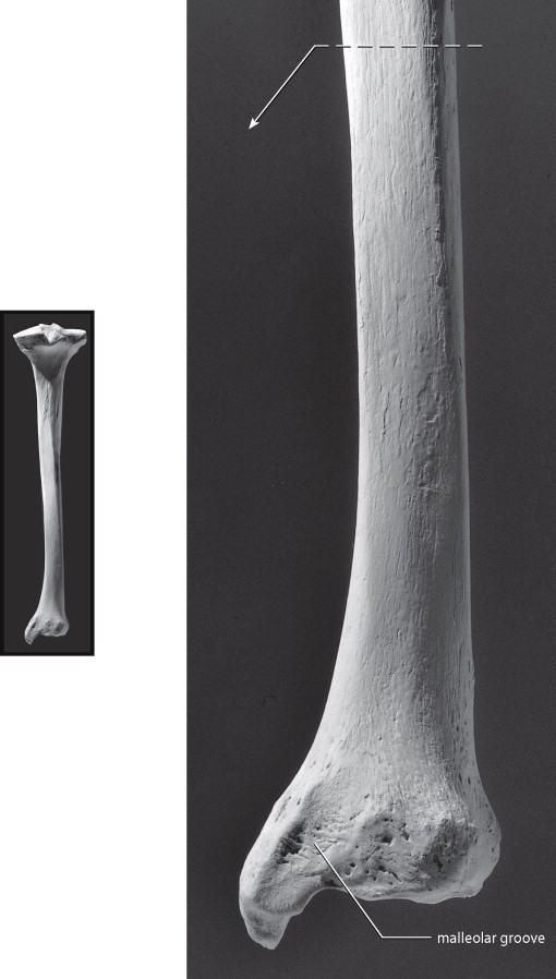 <p>distal, on medial malleolus</p>