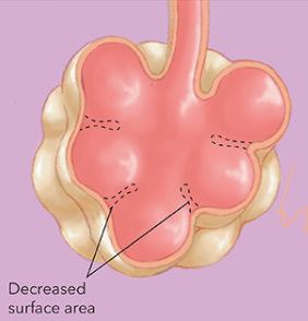 <p>Type of COPD where <span><span>the alveoli walls break down, reducing the surface area for gas exchange and trapping carbon dioxide in the lungs.</span></span></p>