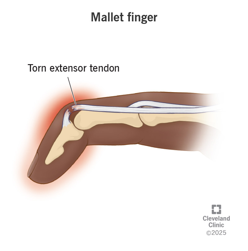 <p>trauma to extensor tendon at DIP often by direct trauma can sometimes pull off a small piece of bone, causing slight flexion and difficulty straightening. </p><p></p>
